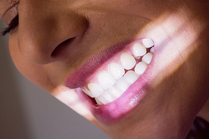 Blanqueamiento dental en Sevilla
